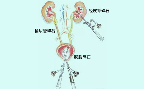 鈥激光手術(shù)系統(tǒng)