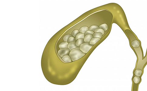 膽囊結(jié)石