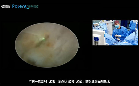 經尿道120W鈥激光前列腺剜除術