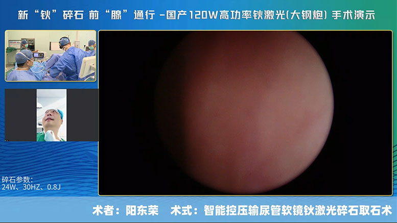智能控壓輸尿管軟鏡鈥激光碎石取石術(shù)