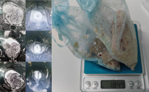 前列腺增生腺體