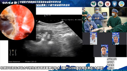 軟鏡碎石取石術(shù)聯(lián)合可視經(jīng)皮腎鏡腎囊腫切除術(shù)（國(guó)產(chǎn)120W高功率鈥激光/大鋼炮）