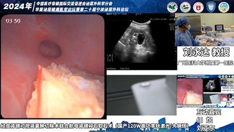經(jīng)皮腎鏡可視腎囊腫切除術(shù)聯(lián)合航母腎鏡碎石取石術(shù)（國(guó)產(chǎn)120W高功率鈥激光/大鋼炮）
