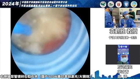 輸尿管軟鏡碎石取石術(shù)（國(guó)產(chǎn)120W高功率鈥激光/大鋼炮）
