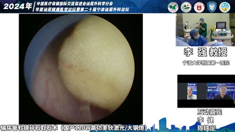 輸尿管軟鏡碎石取石術(shù)（國(guó)產(chǎn)120W高功率鈥激光/大鋼炮）