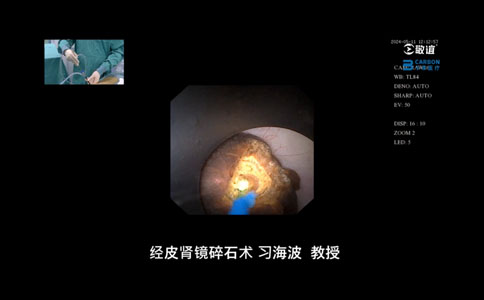 大鋼炮經(jīng)皮腎鏡碎石術