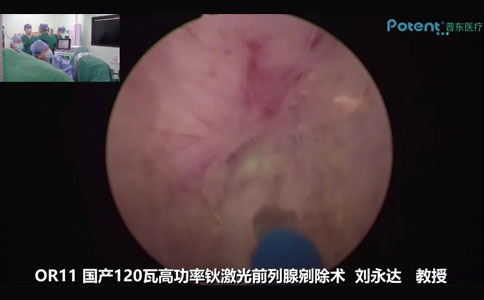 國產(chǎn)120W高功率鈥激光前列腺剜除術(shù)