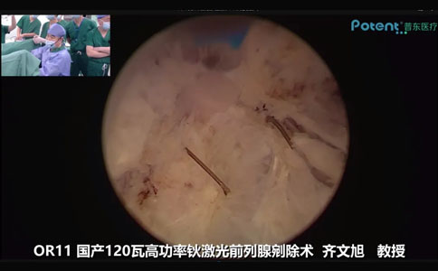 國產(chǎn)高功率鈥激光前列腺剜除術(shù)