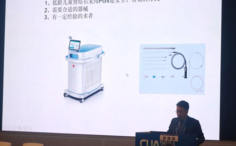 高功率鈥激光在兒童碎石中的獨特優(yōu)勢