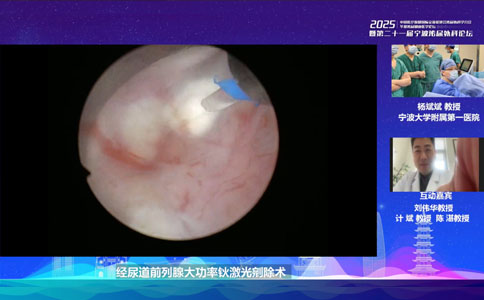經(jīng)尿道前列腺大功率鈥激光