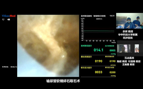 輸尿管軟鏡碎石取石術(shù)