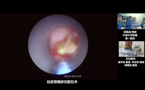 經(jīng)皮腎鏡碎石取石術(shù)